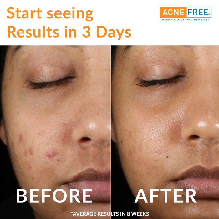 AcneFree Oil Free 24 HR Acne Clearing System, 3 Piece Kit, , large
