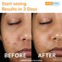 AcneFree Oil Free 24 HR Acne Clearing System, 3 Piece Kit, , large image number 3