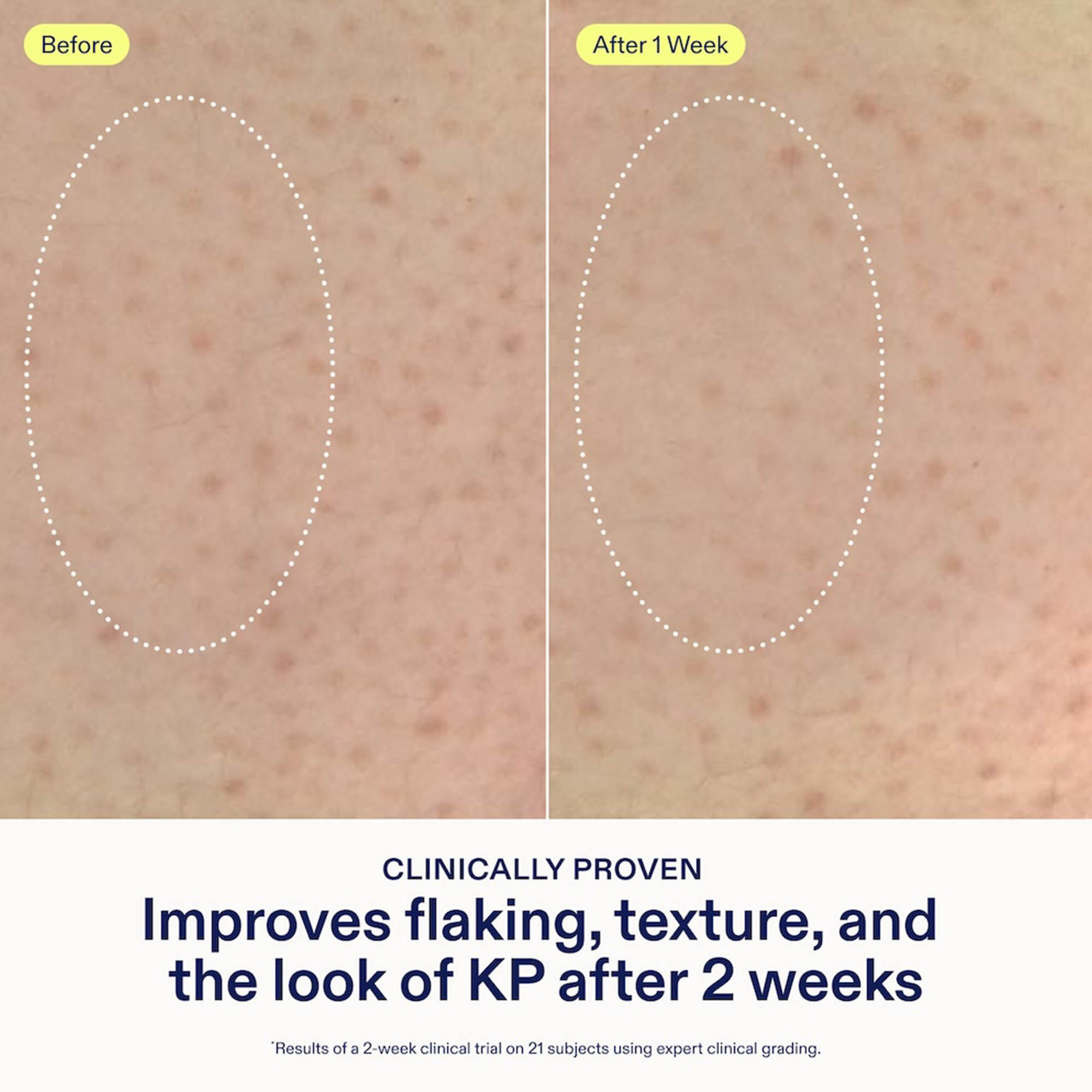 Skinfix KP PsO Smoothing Body Treatment, 5.07 fl. oz., , large