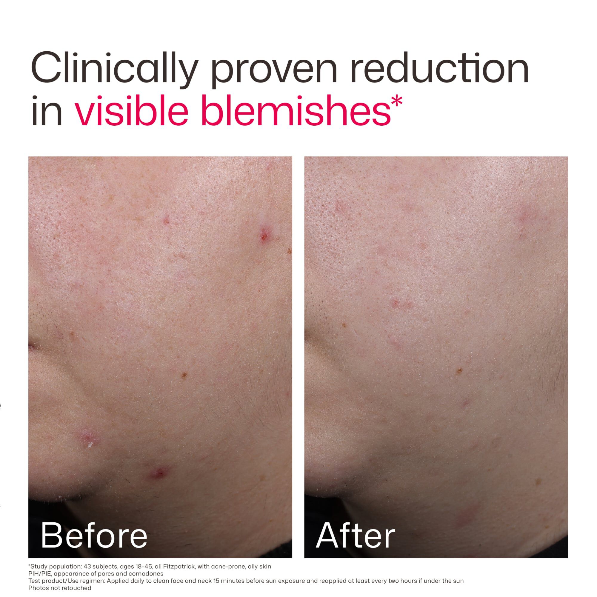 EltaMD UV Clear Blemish-Prone & Oil Balancing, SPF 50, 1.7 oz., , large